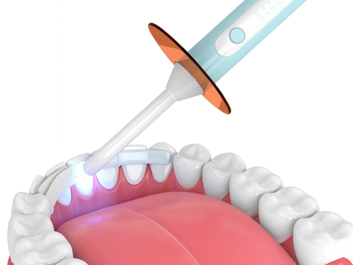 Dental-Bonding-2-1365x1024_new
