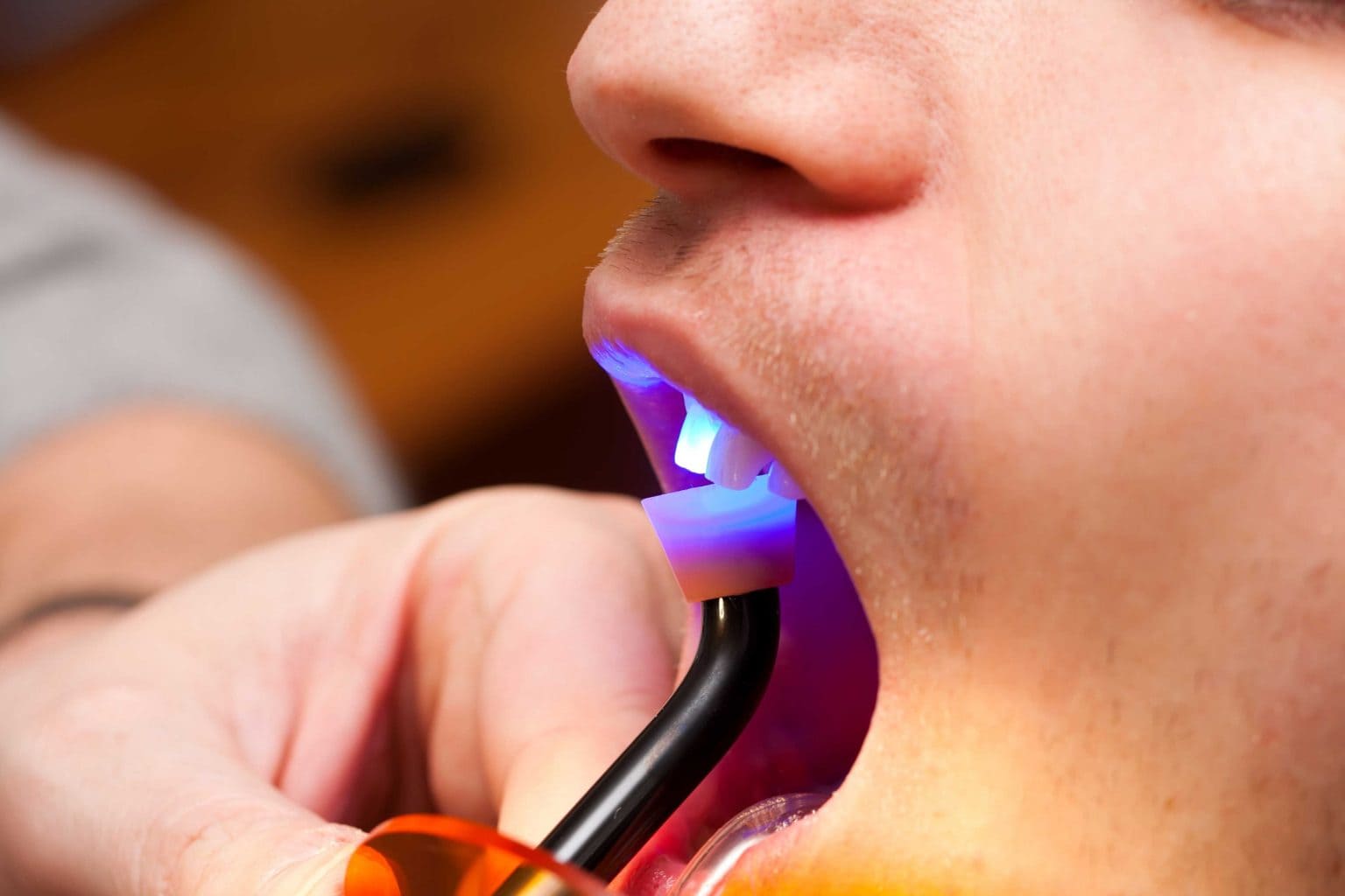 Dental-Bonding-6-1536x1024_new